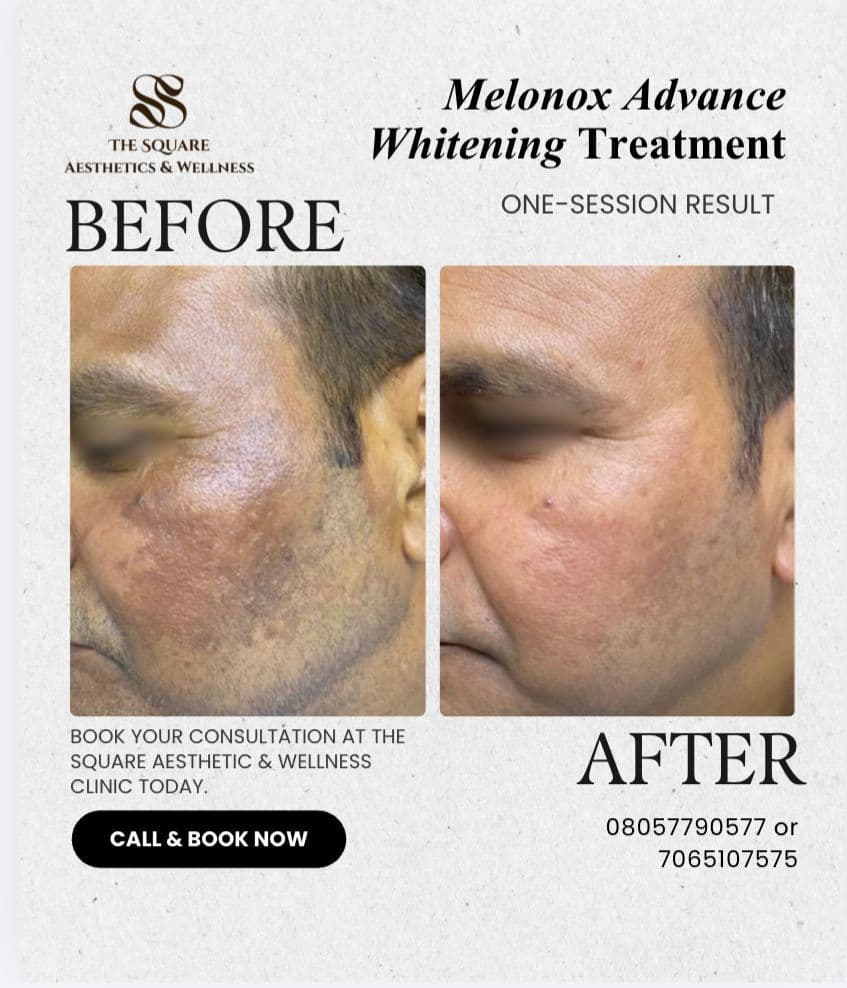 Before and after transformation at The Square Aesthetics & Wellness Clinic