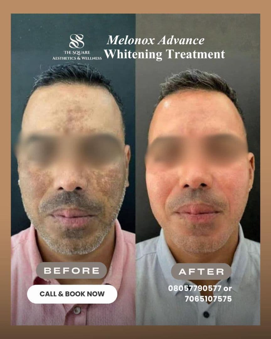Before and after transformation at The Square Aesthetics & Wellness Clinic