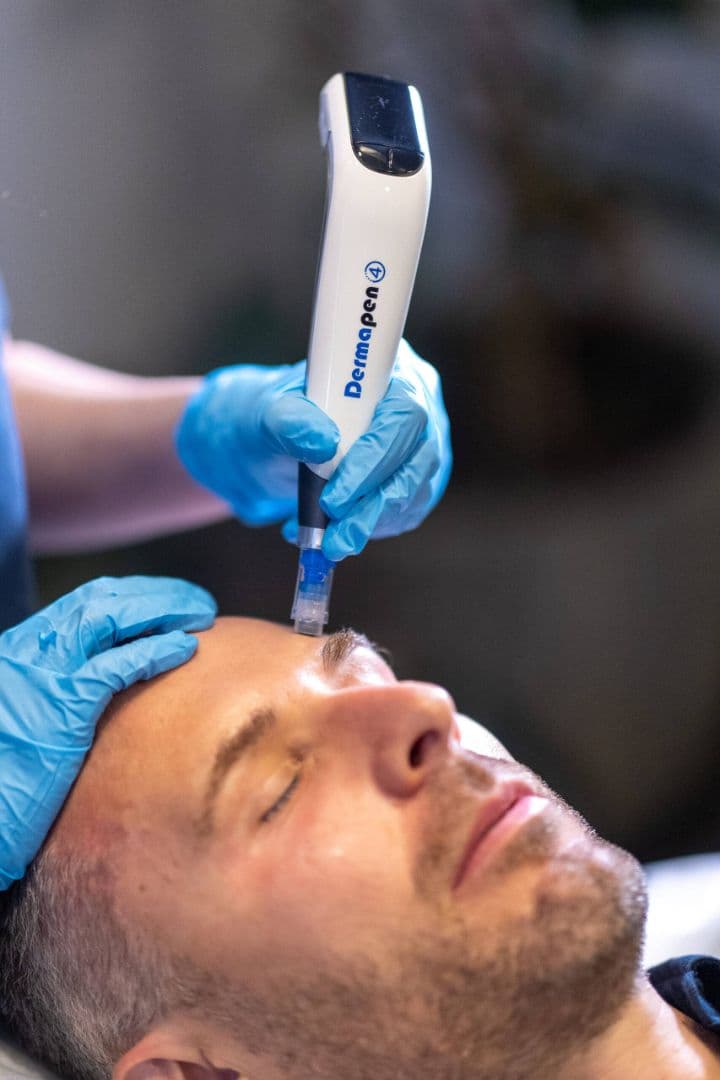 Dermapen 4 at The Square Aesthetics & Wellness Clinic, Rajouri Garden, Delhi